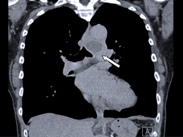 De thoraxfoto toont een afwijking in het aorta-pulmonale venster passende bij een sacculair aneurysma.