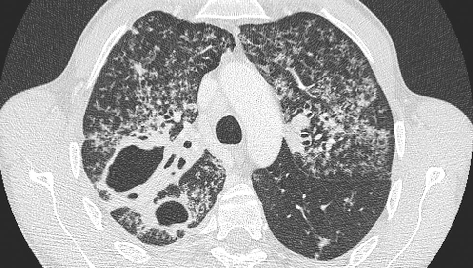 2. CT-thorax met apicaal in de bovenkwab meerdere holtevormende afwijkingen met bronchiëctasieën en kleine consolidaties (tree-in-bud-afwijkingen).