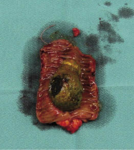 Het resectiepreparaat van de dunne darm werd opengeknipt en toonde een galsteen van 3,5 bij 6 centimeter. beeld: auteurs