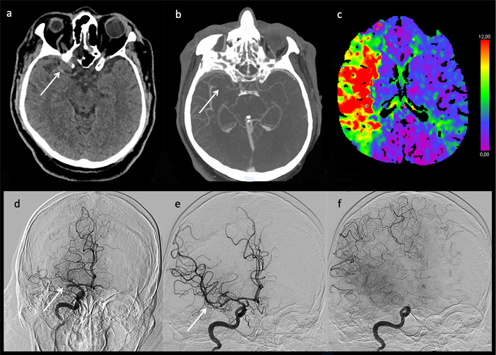 2. Röntgenfoto’s na hersen­infarct (2021). Röntgenbeelden van een patiënt met een acuut hersen­infarct van de rechterhemisfeer in 2021. a: Dense middle cerebral artery sign (pijl), b: CT-angiografie met contrastonderbreking op de plaats van de trombus, c: CT-perfusiebeeld: het groene en gele gebied geeft matige, en het rode gebied geeft forse verstoring van de perfusie aan, d: digitale subtractieangiografie (DSA) met afsluiting door trombus (pijl), e: DSA na trombectomie, met weer doorgankelijke arteria cerebri media (pijl), f: late DSA-opname toont goede contrastverdeling in het stroomgebied van de arteria cerebri media.   
