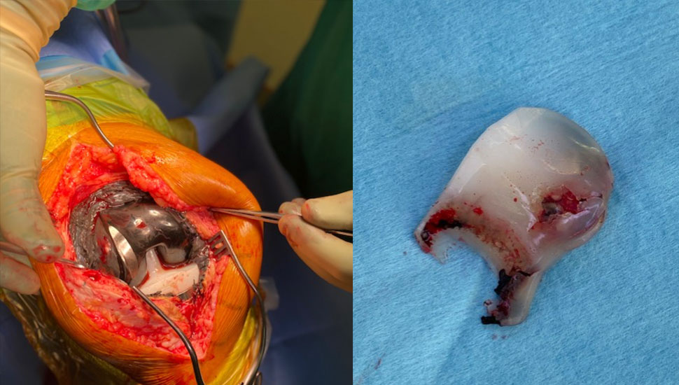 2. Links: Revisiechirurgie van rechterknie. Duidelijke slijtage van laterale femurcomponent met donker metalloseweefsel | Rechts: PE-wear van patellacomponent.