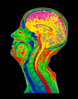 Met MRI kan atrofie van de hersenen worden aangetoond. Het roze gebied is aangetast. Beeld: ANP Photo