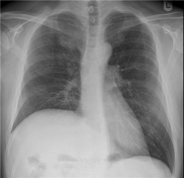 X-thorax (PA-opname) van 49-jarige patiënt met kortademigheid en krachtsverlies in de armen. De X-thorax toont een hoogstand van het rechterhemidiafragma. - Beeld auteurs