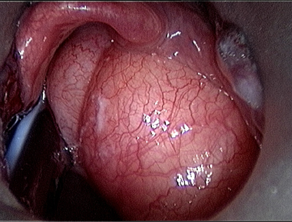 Door de scoop wordt een grote zwelling gezien die de epiglottis verdrukt.