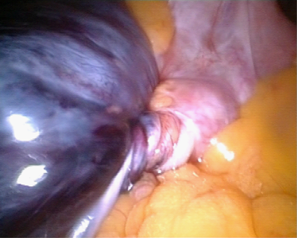Bij de operatie wordt een donkerblauw verkleurde, driemaal om zijn as getordeerde adnex gezien.