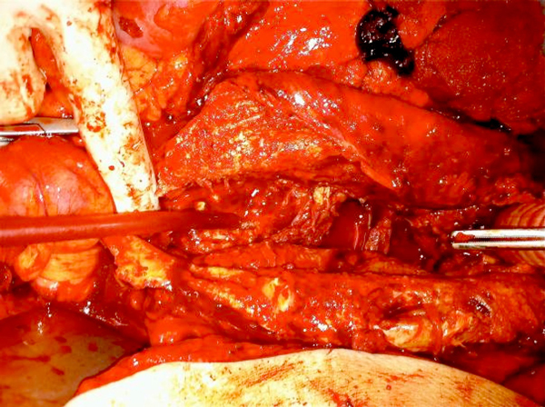 Intraoperatief aanzicht: het aneurysma is geopend. De proximale anastomose is reeds ingehecht (rechts op de foto). Er is direct zicht op de gedestrueerde wervelkolom.