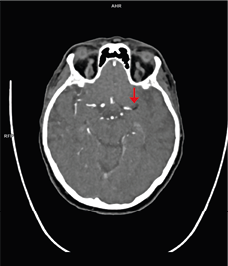 figuur 1. CT-angiografie toont een occlusie door een lineaire, sterk hypodense afwijking in de arteria cerebri media links (pijl), suggestief voor een vetembolus.