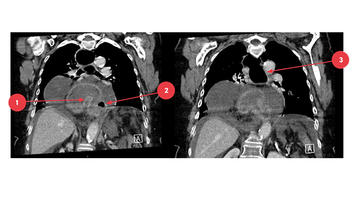 CT-thorax: 1. craniocaudaal georiënteerde torsie van de maag 2. vrij lucht 3. dilatatie van de proximale oesofagus met lucht gevuld