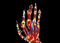 Een gekleurde röntgenopname van een door jicht aangetaste hand. De gewrichtspleten zijn versmald en de blauwe vlekken in de gewrichten wijzen op boterosie. beeld: ANP Photo