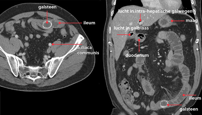 Transversaal (links) en coronaal (rechts) opname van de CT-abdomen waarbij de obstruerende galsteen zichtbaar is in de dunne darm. Er is sprake van lucht in de galblaas (aerobilie) (rechts).   