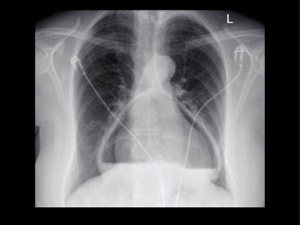 Foto 1. X-thorax preoperatief, waarop de intrathoracaal gelegen maag duidelijk te herkennen is aan de vloeistofspiegel.
