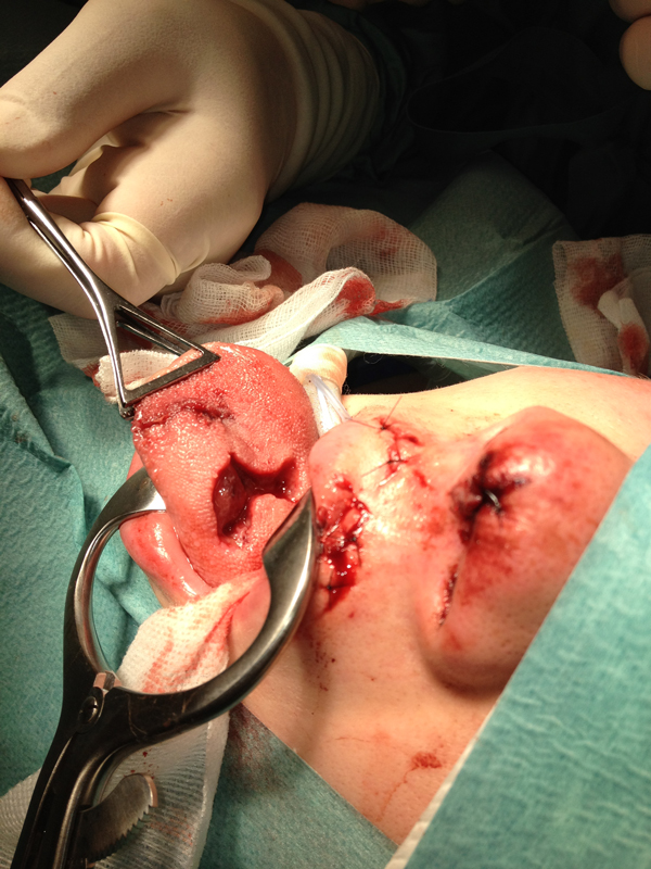 Na hechten van het voorste deel van de tong blijkt er een tweede, groter defect in het proximale deel te liggen. Plaatsing van de foto met toestemming van de patiënt.