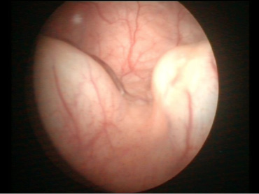 1. Cystoscopie met beeld van ureterocele beiderzijds.