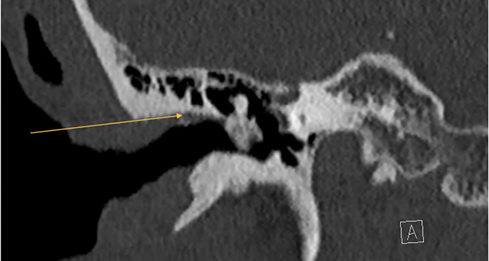 3. CT-scan met benig neoplasma in meatus acusticus externus rechts met betrokkenheid van de malleus.