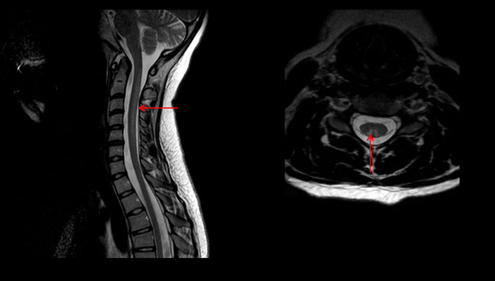 Sagittale en transversale T2-gewogen MRI-scan van de cervicale wervelkolom. Dorsaal in het myelum ter hoogte van de achterstrengen, met name van de fasciculus cuneatus beiderzijds is er een langgerekt hyperintens signaal zichtbaar vanaf het wervellichaam C2 tot en met C5. - Beeld auteurs.