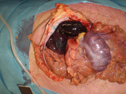 Tijdens spoedlaparotomie blijken delen van het omentum majus, het colon transversum en de dunne darm necrotisch te zijn.
