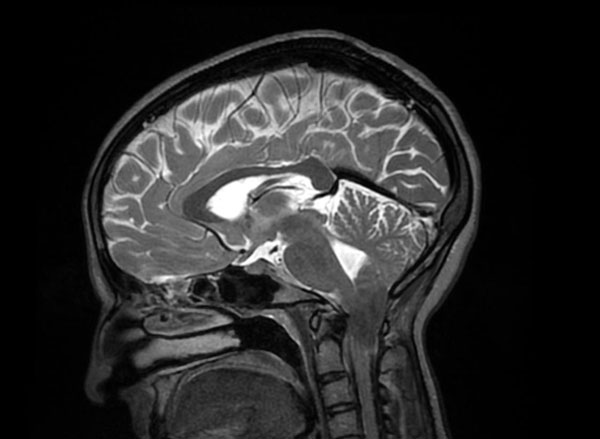 MRI-cerebrum, sagittale T2-opname: cerebellaire tonsillen zijn ingedaald tot in het foramen magnum.