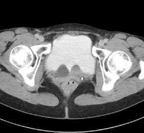 3. CT-abdomen met excretiefase, transversale coupe. Blaas gevuld met contrast waarbij het beeld van ureterocele beiderzijds. Aan de linkerzijde tevens een klein concrement in de ureter zichtbaar.