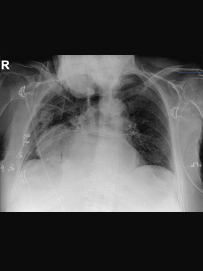 X-thorax met paracardiale densiteit rechts