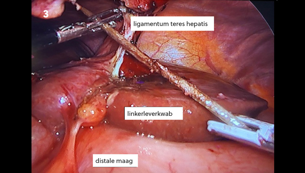 Intraoperatief beeld van de lever en het gekliefde ligamentum teres hepatis. Onder in beeld de maag tegen de lever aan verkleefd.   