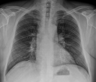 X-thorax: verbreed aspect bovenste media-stinum en forse hili beiderzijds.