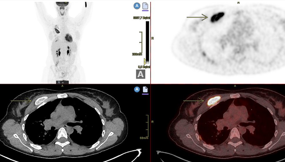 PET-CT-scan: hypervasculaire massa in de pectoralis rechts met prominente lymfe­klieren axillair rechts. 28 x 64 x 16 mm. De laesie is PET-actief.   