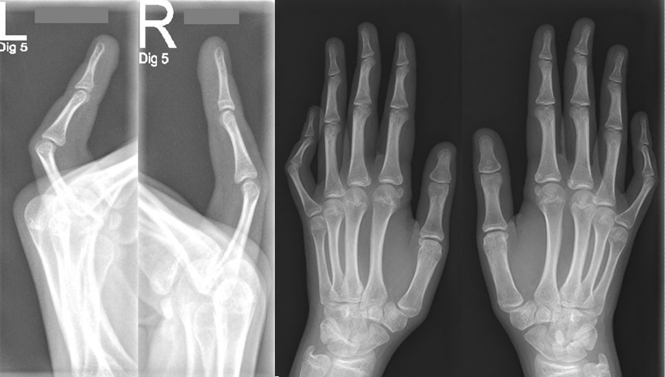 Foto 3 en 4: De röntgenfoto toont een flexiestand in het PIP-5-gewricht beiderzijds zonder verdere afwijkingen.   