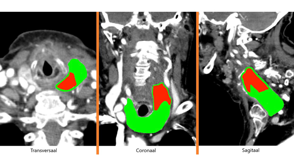 Foto 2: CT-scan hals: vergroot linkerhemithyroïd met craniaal een scherpbegrensde sub­capsulaire hypodensiteit, passend bij een thyroïdbloeding zonder aanwijzingen voor mechanische compressie op de trachea. Groen: schildklier, rood: hematoom.