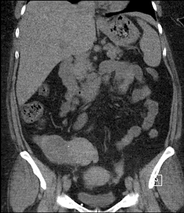 Coronale doorsnede CT-scan: cysteuze afwijking, die onderdeel lijkt te zijn van het rechteradnex.