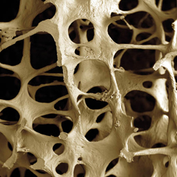 Een bot van een 89-jarige vrouw met osteoporose. Beeld: Corbis