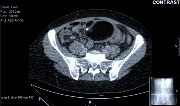 Een CT-abdomen met contrast toont een solide massa van circa 7 bij 10 cm met verkalkingen erin, die suspect is voor een teratoom.