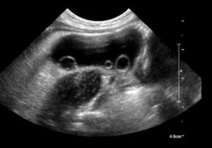 figuur 1. Echografie van de ovariële cyste met daarin meerdere intern wandstandige kleine dochtercysten. <i>Beeld: auteur</i>