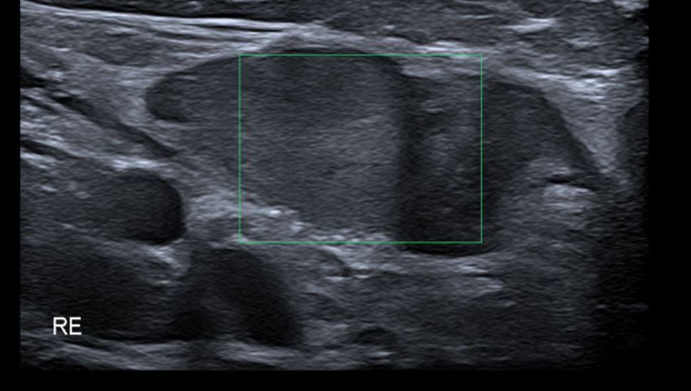 Duplexechografieopname van de inguinaal gelegen rechtertestis. Hierop is zichtbaar dat een testiculaire vascularisatie ontbreekt.
