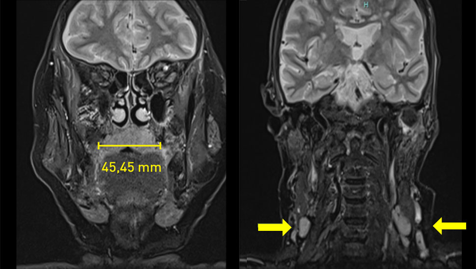 MRI brughoek: forse scherp afgrensbare tumormassa in orofarynx uitgaande van palatum molle, afmetingen 51 x 45 x 33 mm. Ook forse lymfadenopathieën in de hals bilateraal