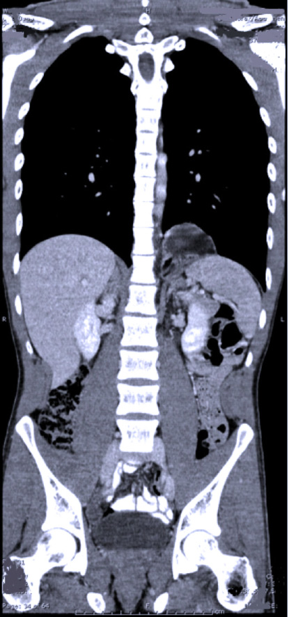 CT-thorax abdomen één jaar na het ongeval.