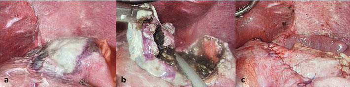  2Intraoperatieve laparoscopische beelden: a. necrose van de maagwand b. resectie van de necrotiserende maagwand en c. het sluiten van het defect.   