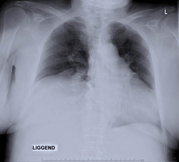 X-thorax preoperatief. Hierop is hemidiafragmahoogstand rechts te zien. 