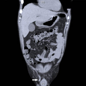 Distaal deel appendix zichtbaar in scrotum