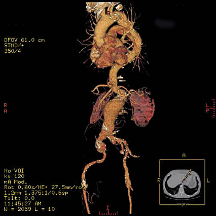 Een CT-scan van een aorta met aneurysma. De diameter van een AAA is bepalend voor het risico op scheuring. beeld: auteur