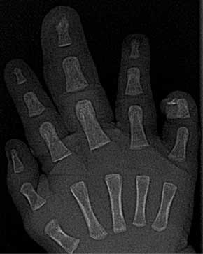 Röntgenfoto van de rechterhand, zes weken na de geboorte.