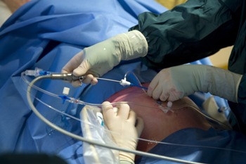 De foetusscoop wordt ingebracht in de buik voor een laserbehandeling vanwege het tweelingtransfusiesyndroom.