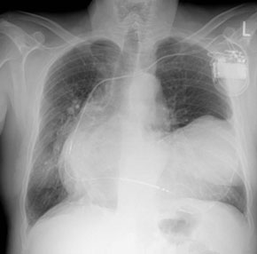 1 PA-afbeelding van een röntgenfoto van de thorax