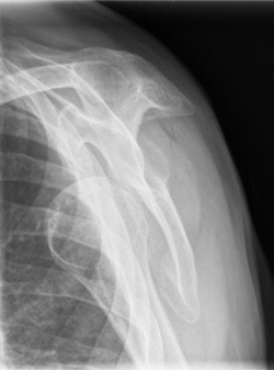 Het röntgenbeeld bevestigt dat er sprake is van een anterieure schouderluxatie en toont tevens een avulsiefractuur van het tuberculum majus.