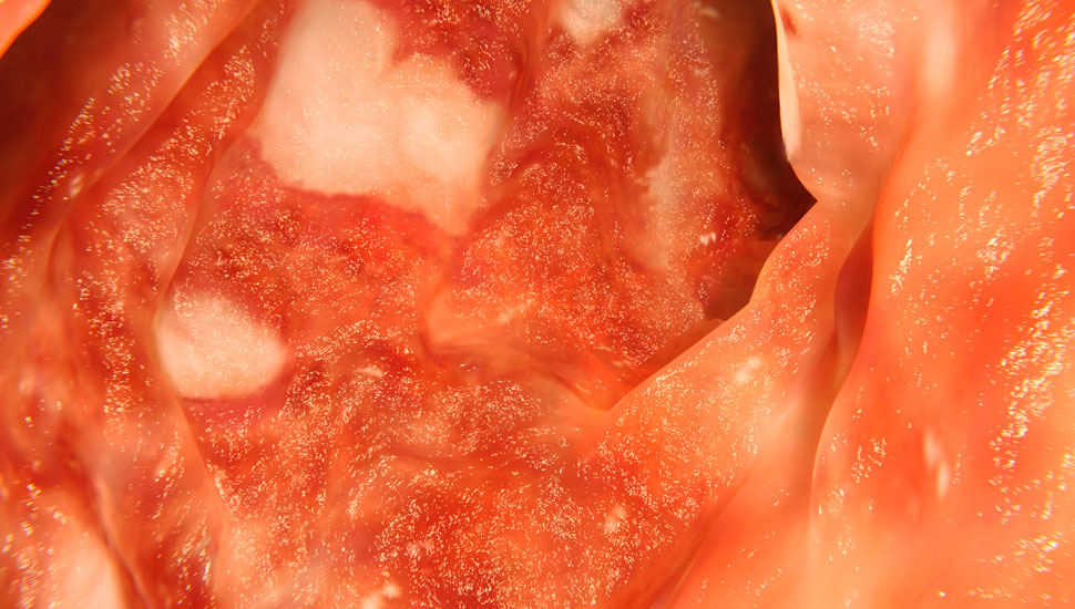 Impressie van een door colitis ulcerosa aangedane dikke darm. - Getty Images