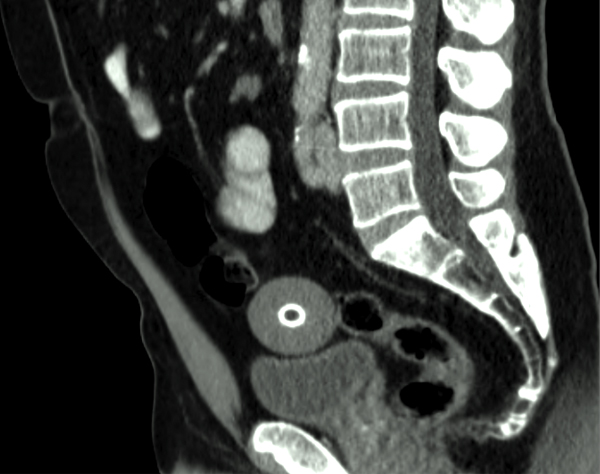 De CT-scan toont het intra-abdominale proces met een centrale verkalking craniaal van de blaas.