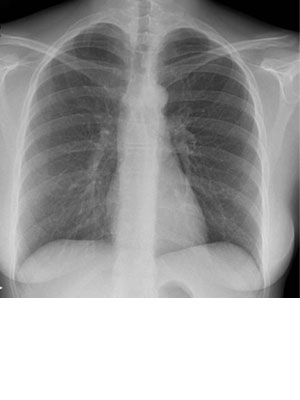 2. Beeld auteurs. X-thorax met beiderzijds cervicale ribben.