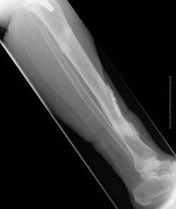 2. Laterale röntgenopname van het linkeronderbeen met vorderende consolidatie van de eerdere fractuur, nu is ook een tweede insufficientiefractuur zichtbaar ter hoogte van de proximale tibia. beeld auteurs