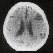 B. Deze scan laat een infarct links zien, op de grens tussen de stroomgebieden  van de a. cerebri anterior en de a. cerebri media.