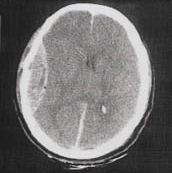 C. Deze scan laat een epiduraal hematoom zien. Het hematoom ontstaat door scheuring van een meningeale arterie en veroorzaakt een bloeding tussen de schedel en de dura mater.