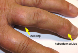 Op de middelvinger van de linkerhand wordt net distaal van het PIP-gewricht een weke zwelling gezien.